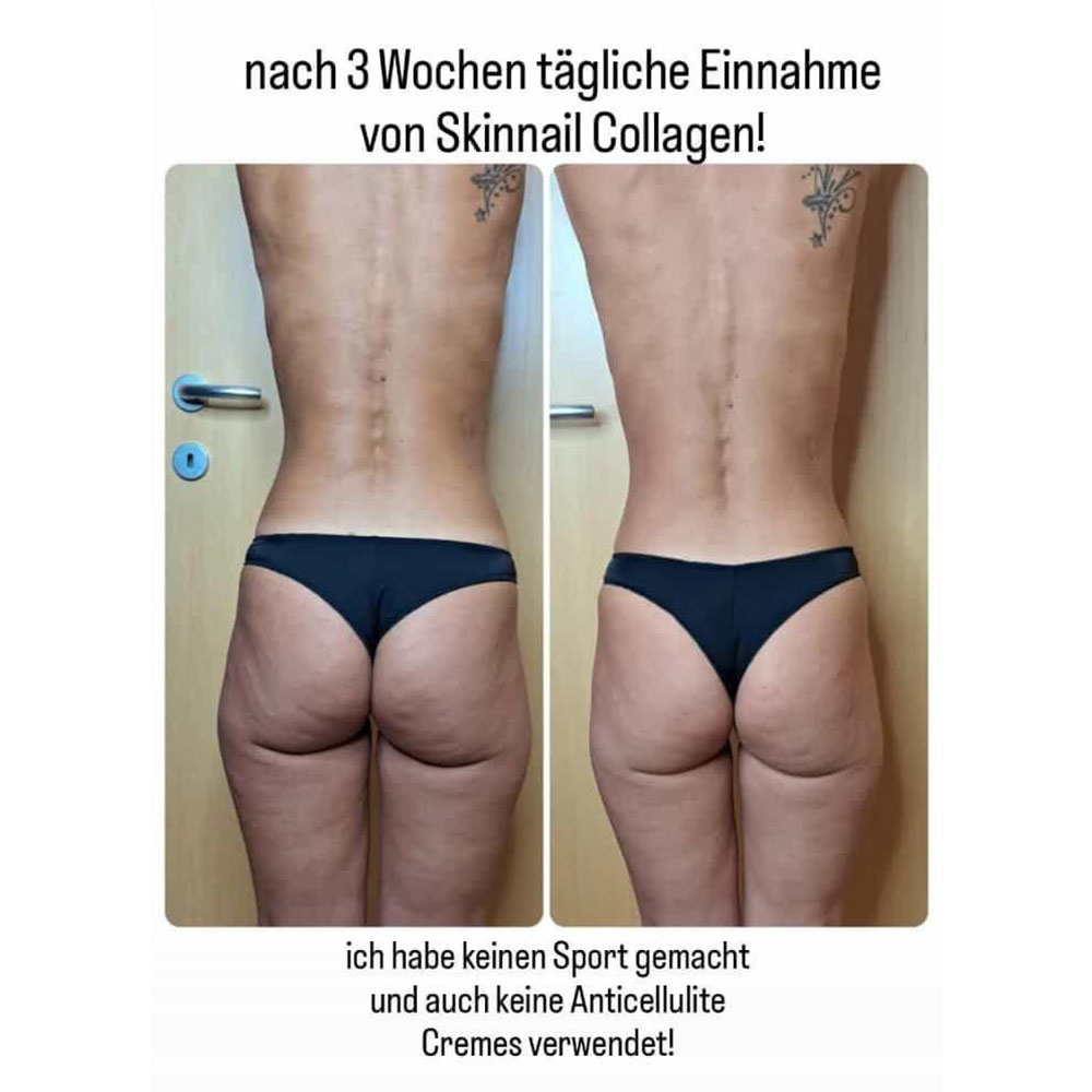 kollagen-celuitte-vorher-nachher