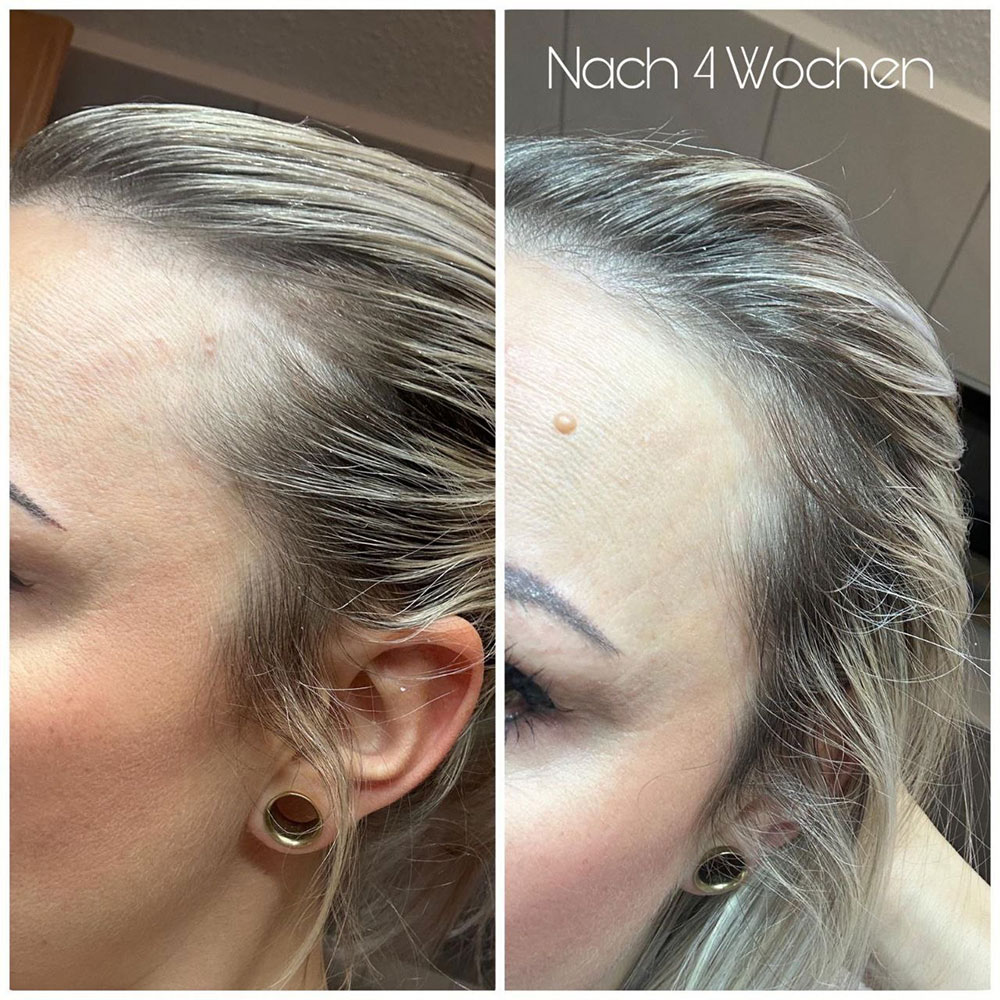 kollagen-gesicht-vorher-nachher