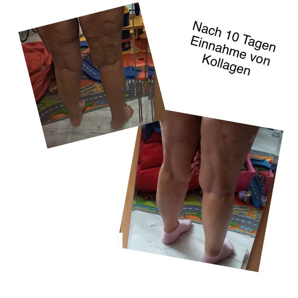 kollagen-vorher-nachher